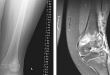 Knock knees in children: why it happens and when medical attention is required