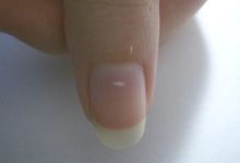 What changes in your nails may reveal about nutrition, trauma and chronic disease