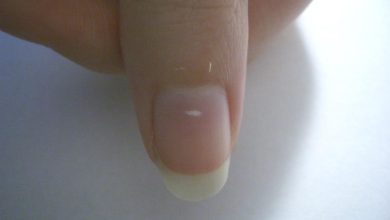 What changes in your nails may reveal about nutrition, trauma and chronic disease