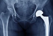 Infections, fractures increasingly driving repeat hip replacement surgeries, finds study