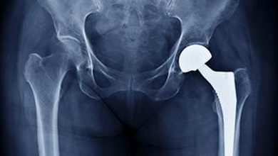 Infections, fractures increasingly driving repeat hip replacement surgeries, finds study