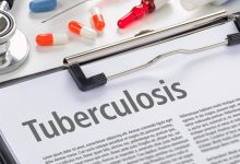 India needs innovative strategies to eliminate TB